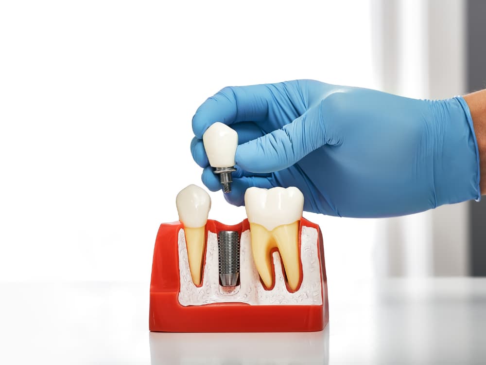 O que considerar na hora de escolher um implantodontista?
