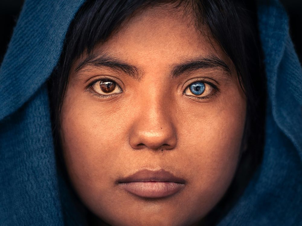 Pessoa com heterocromia nos olhos, condição em que cada olho apresenta uma cor diferente, destacando um olho castanho e outro azul em retrato aproximado.